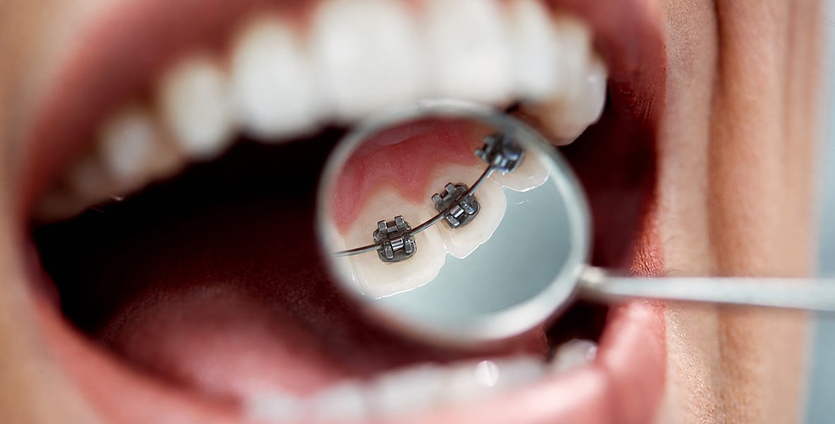 lingual-braket-featured-img
